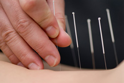 acupuncture treatment