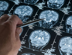 alzheimers disease xray