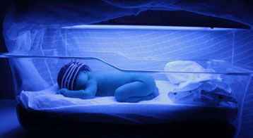 baby with jaundice