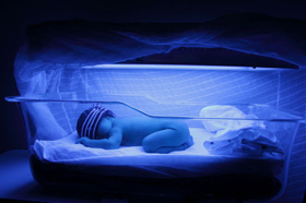 baby with jaundice