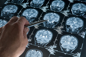 brain scan MRI