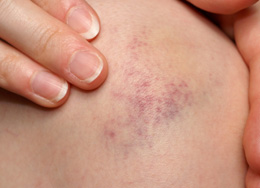 Leukemia Bruises