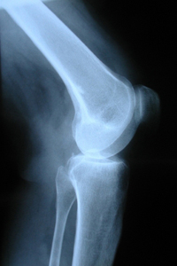 knee xray