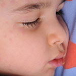 are mumps contagious