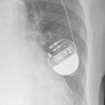 pacemaker