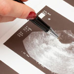 pcos