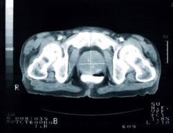 prostate cancer