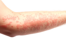 rash on skin