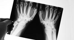 rheumatoid arthritis hands x ray inside