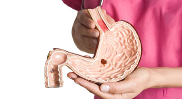 stomach ulcer