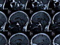 stroke brains mri scans inside