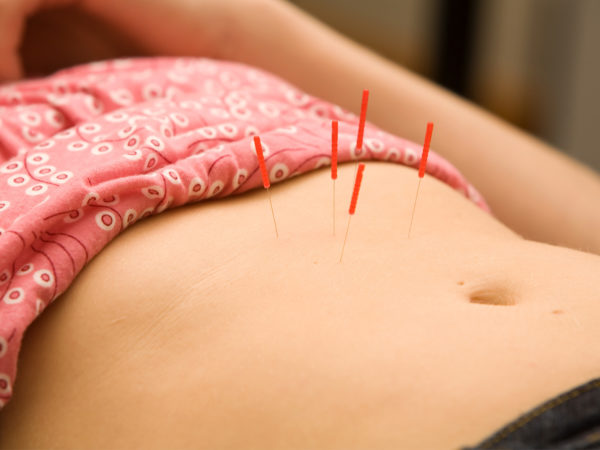 acupuncture weight loss