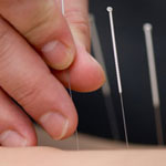 acupuncture preventive