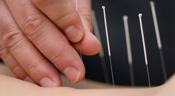 acupuncture treatment