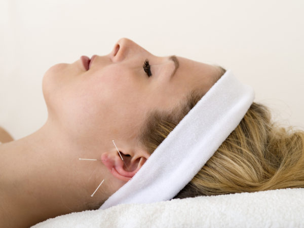 Beautiful woman having acupuncture. Beautiful woman relaxing on a bed having acupuncture treatment with three fine needles in and around her ear lobe