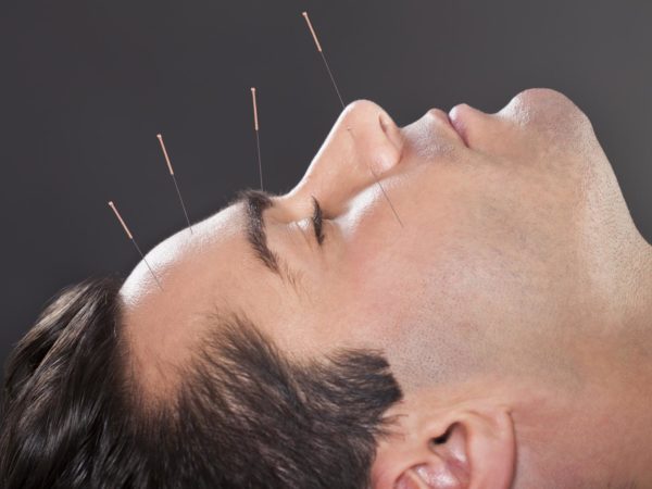 Close-up Of A Young Man Undergoing Acupuncture Treatment At Spa