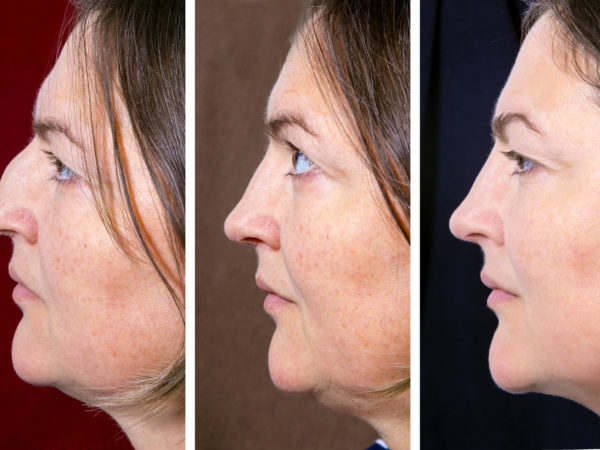 Profile portrait of adult woman with plastic surgery of the nose and double chin - situation BEFORE and AFTER