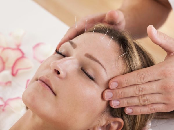 Woman undergoing acupuncture treatment with a line of fine needles inserted into the skin of her forehead