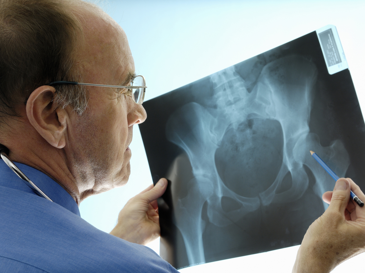 An experienced Caucasian orthopaedic surgeon (doctor) examining a pelvic x-ray displaying signs of osteoporosis - hip degeneration.  Actual x-ray of a 42 year-old woman with a degenerative hip.  The Orthopaedic surgeon is using a pencil to point at the hip where the problem is. This patient is a candidate (real) for hip replacement.  The dominant colour is blue.
