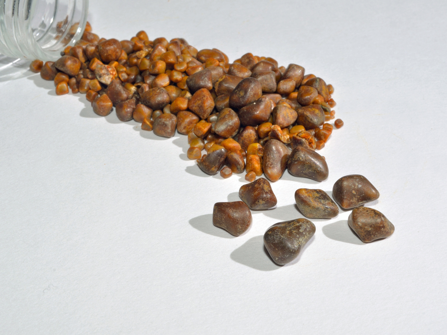 Gallstones and specimen jar from single operation