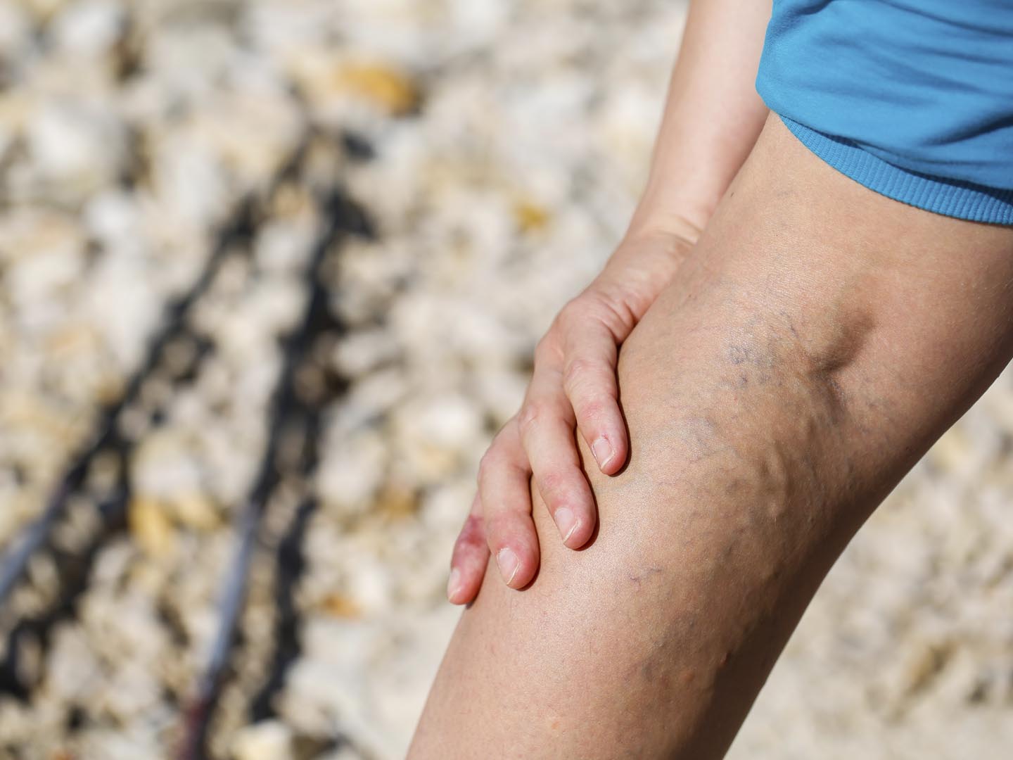 Varicose Veins | Leg &amp; Foot Health | Andrew Weil, M.D.