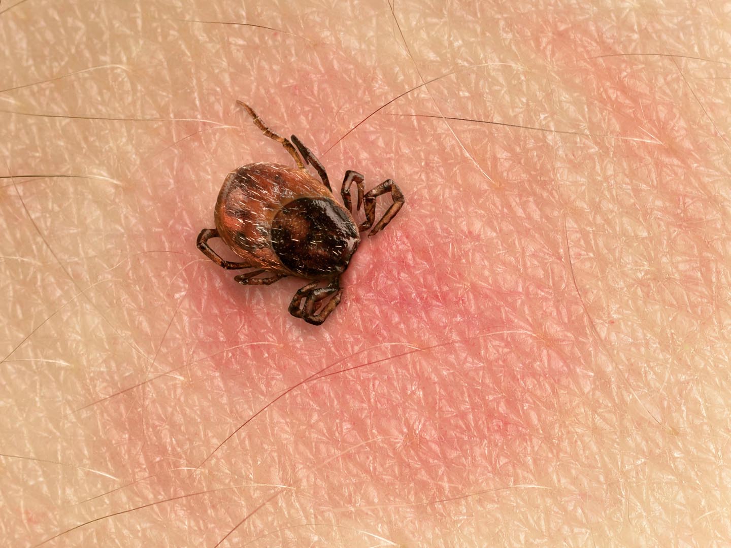 Lyme Disease | Deer Tick | Dr. Weil&#039;s Condition Care Guide