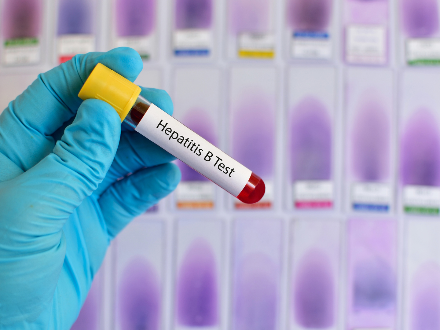 Blood sample for hepatitis B virus testing