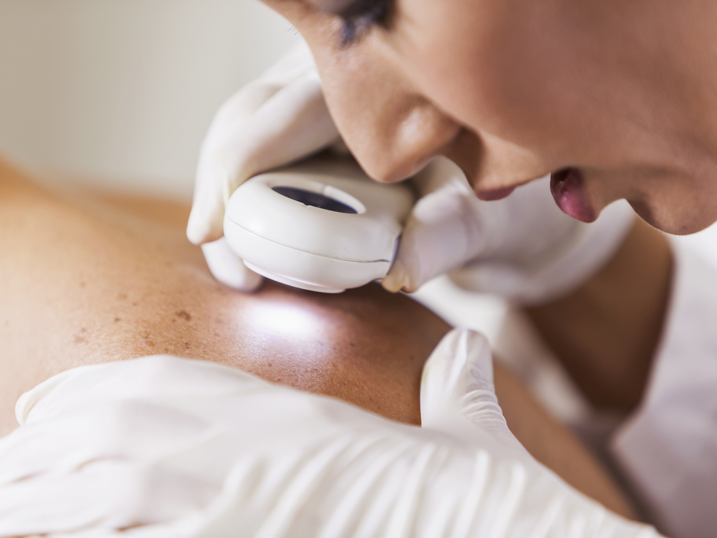 Female dermatologist (30s) examining male patient&#039;s skin with dermascope, carefully looking at a mole for signs of skin cancer.