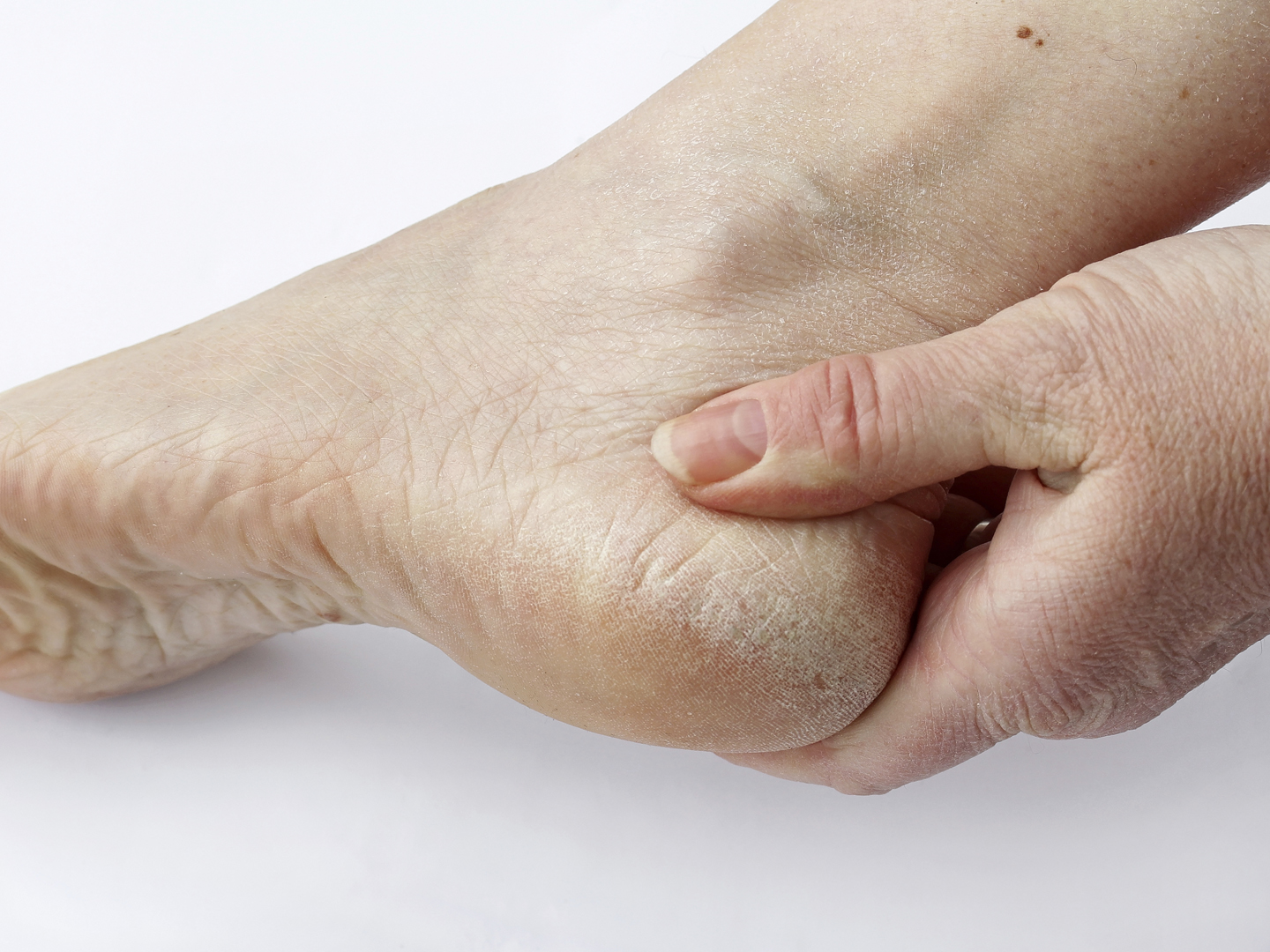 A woman has dry skin and calluses on the feet