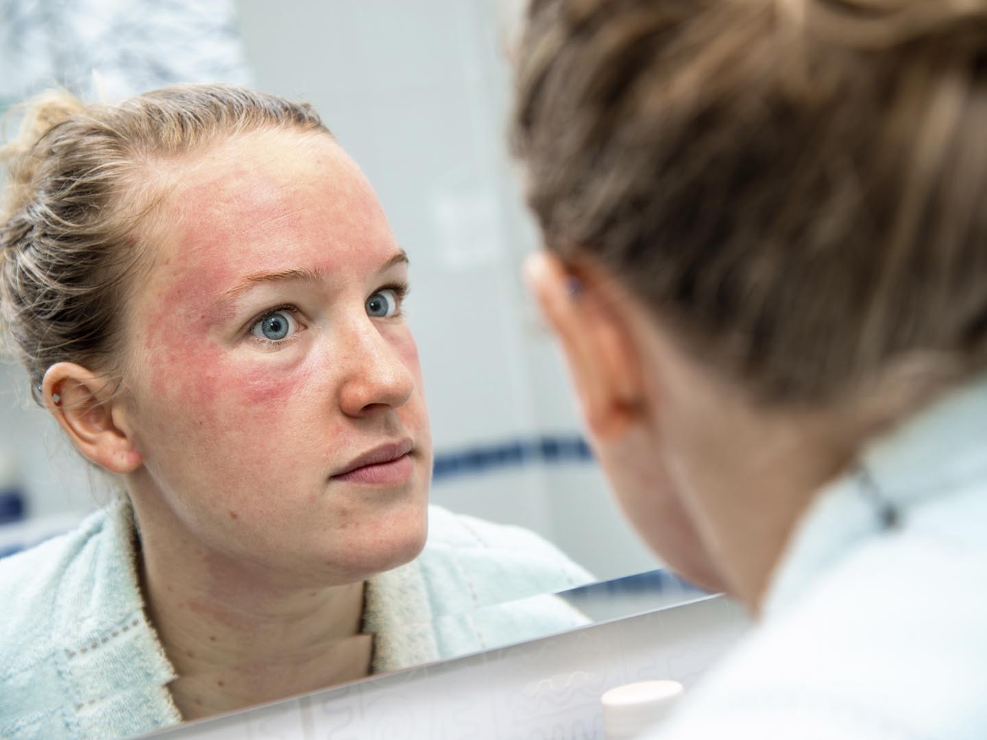 Woman with allergic reaction looking herself in the mirror.