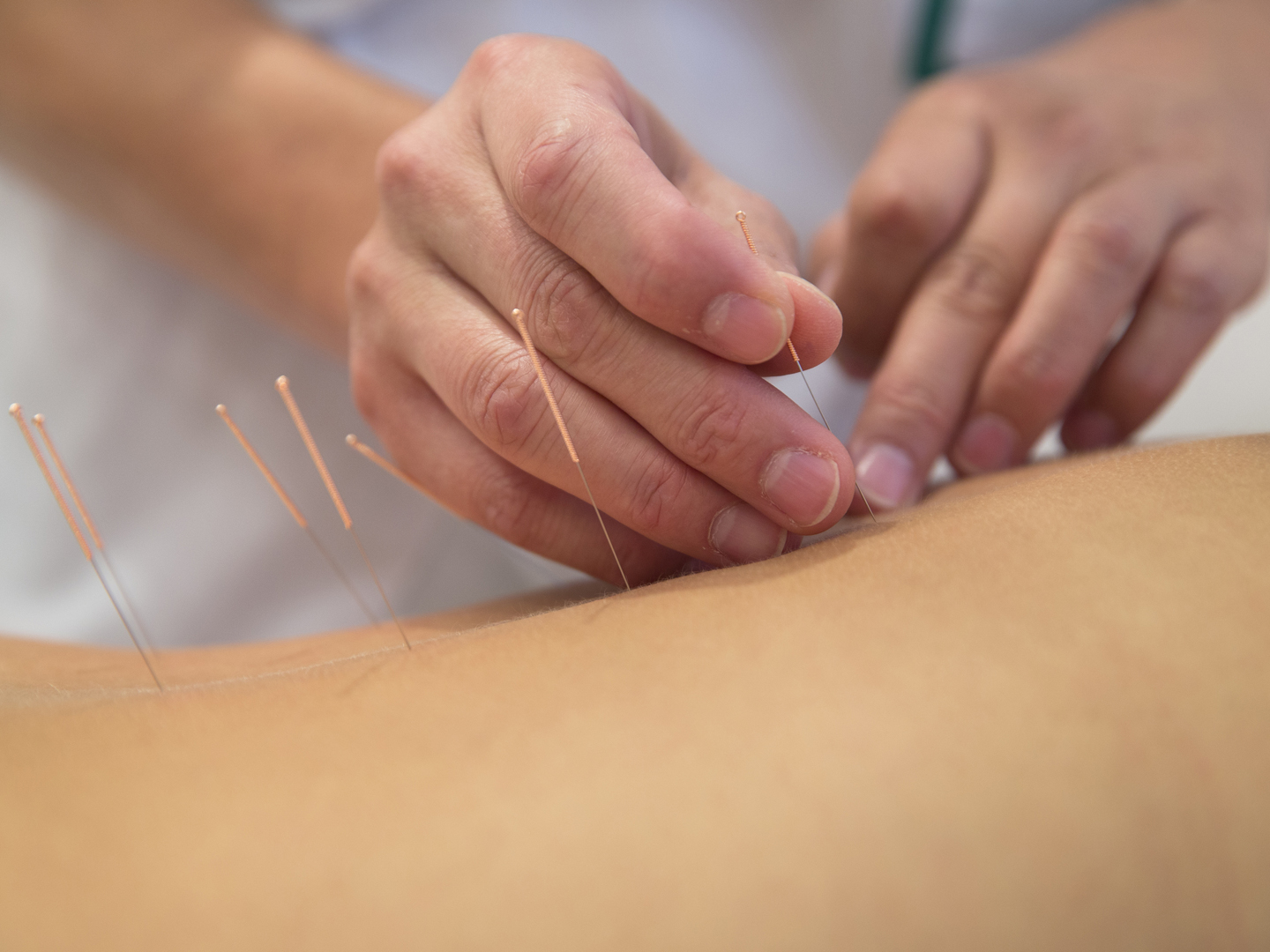 Acupuncture needles on back of a young woman