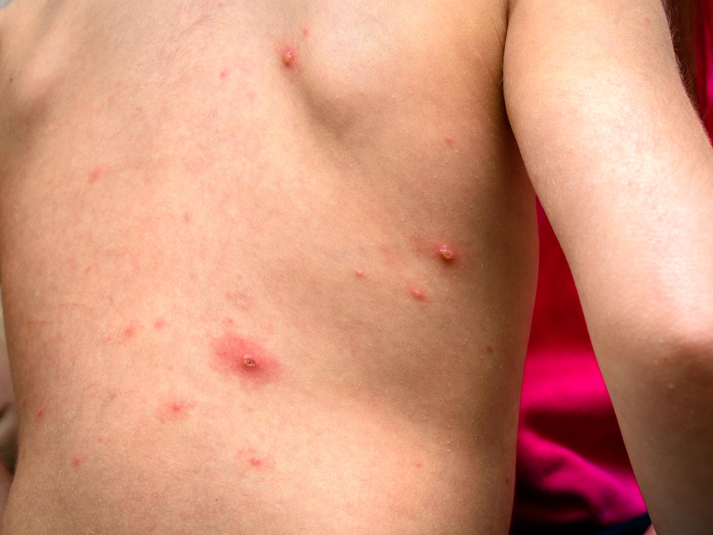 Varicella zoster virus or Chickenpox bubble rash on child, baby or adoult. Closeup image of a fresh blister