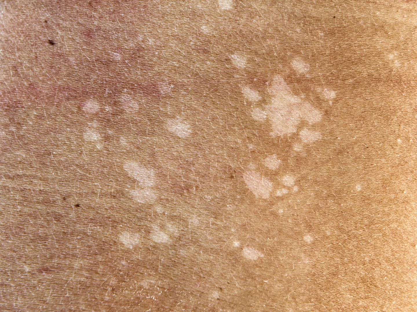 Skin Fungus, Tinea Versicolor on the human back. Nikon D800e. Converted from RAW.