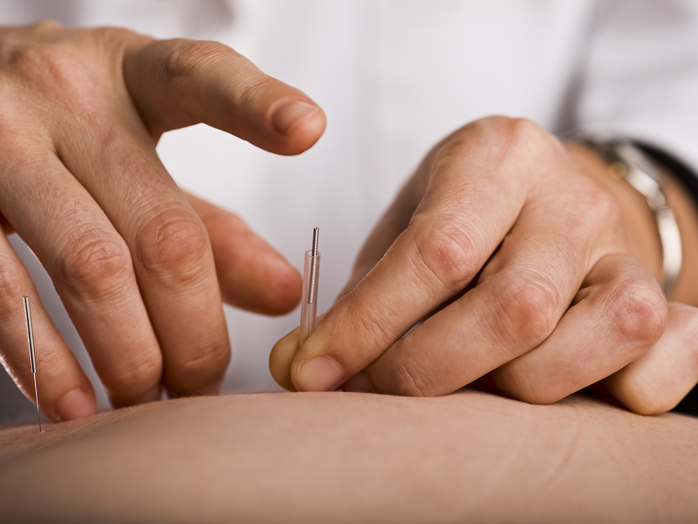 Acupuncturist prepares to tap needle into patients hand