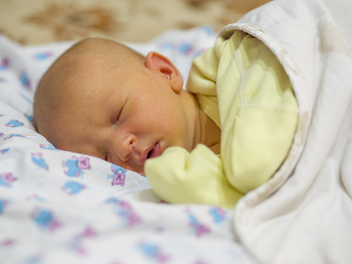 Jaundice in a newborn baby