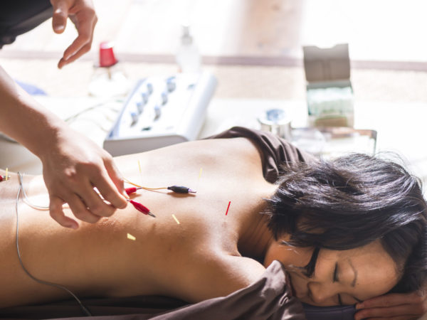 electroacupuncture