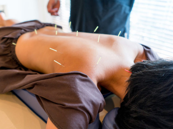 Woman at the acupuncturist with needles placed in her back - Asian culture