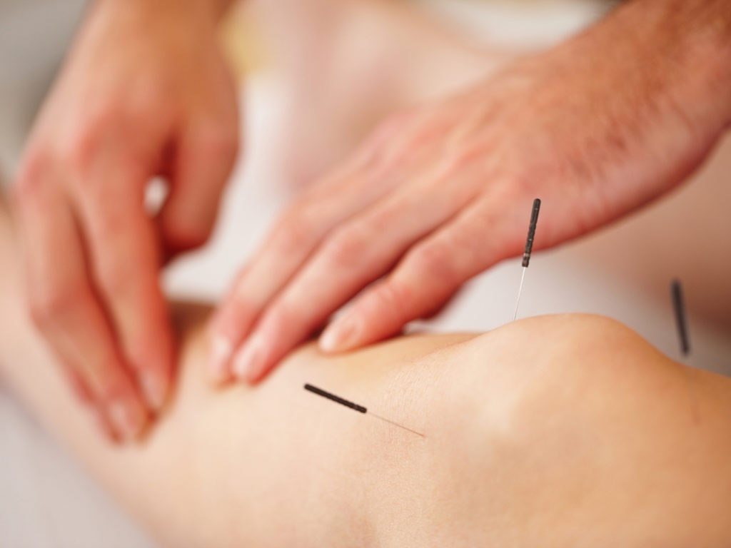Closeup of acupuncture needles with man lightly massaging woman's leg