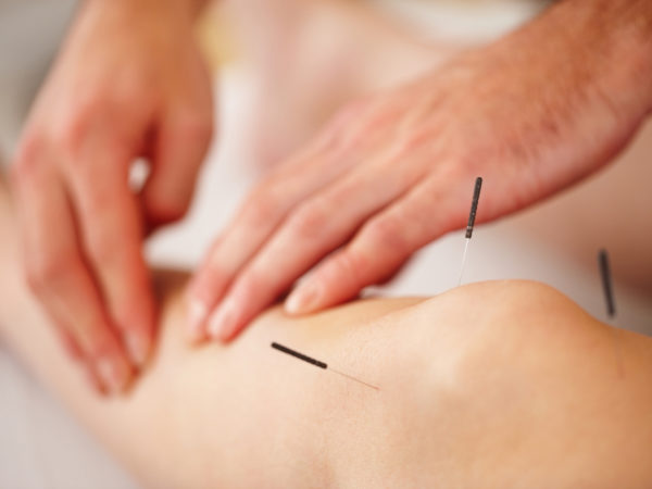 Closeup of acupuncture needles with man lightly massaging woman&#039;s leg