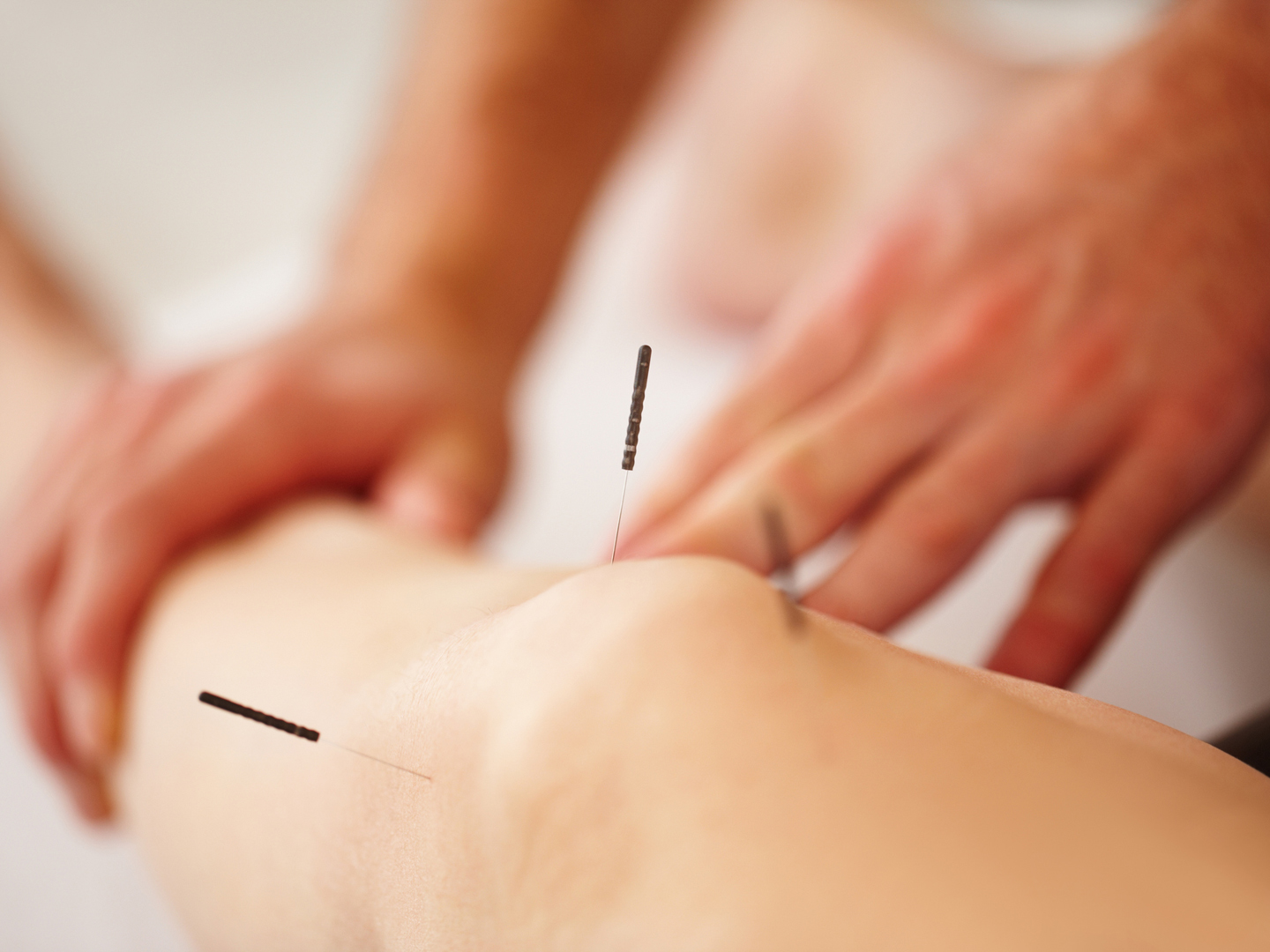 acupuncture treatment