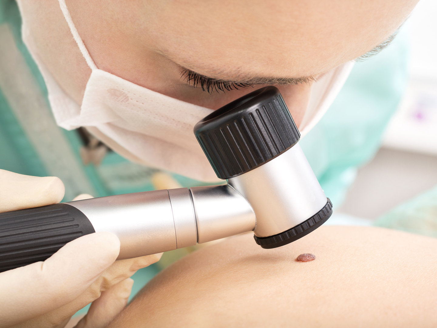 What is the prognosis for melanoma?