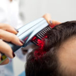 laser treatment for hair loss