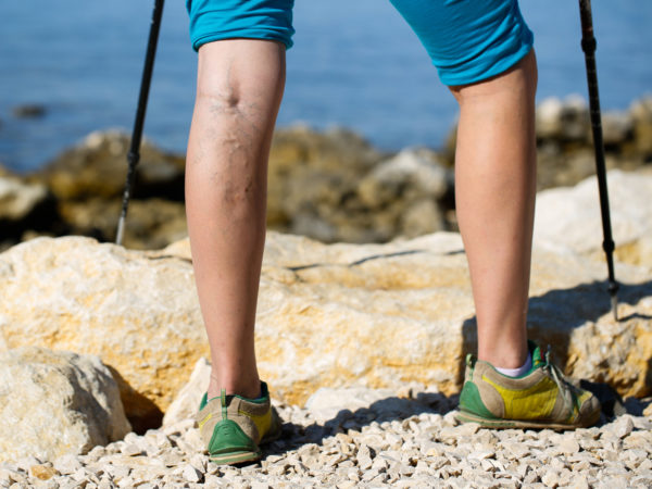 Vexed By Varicose Veins? | Andrew Weil, M.D.