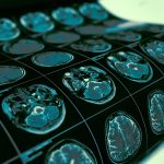 Testing Alzheimer’s Risk | Weekly Bulletins | Andrew Weil, M.D.