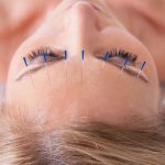 Acupuncture May Help Reduce Tension Headaches | Andrew Weil, M.D.