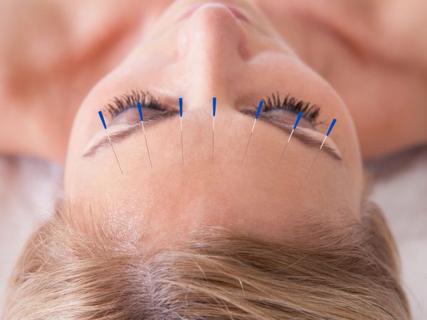 Acupuncture May Help Reduce Tension Headaches | Andrew Weil, M.D.