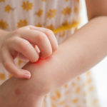 Eczema Prevention Might Start In The Gut | Andrew Weil, M.D.