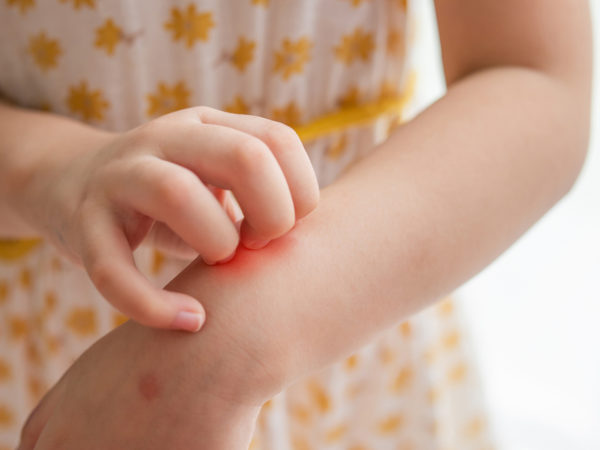 Eczema Prevention Might Start In The Gut | Andrew Weil, M.D.